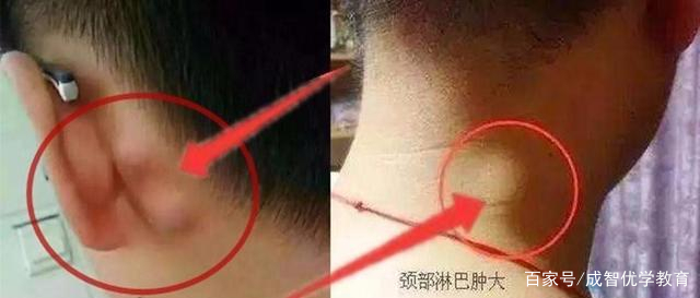瘿瘤图片 baijiahao.baidu.com